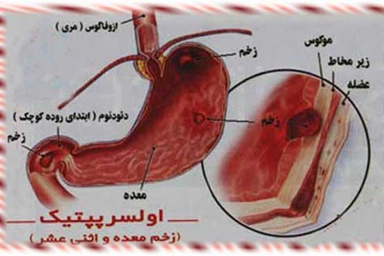درمان زخم معده درمان زخم معده