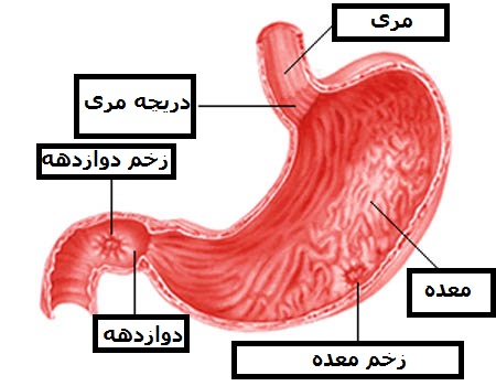 درمان زخم معده